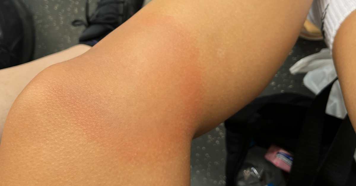 Rekordmånga borreliosfall i Finland efter rekordhöga fästingobservationer