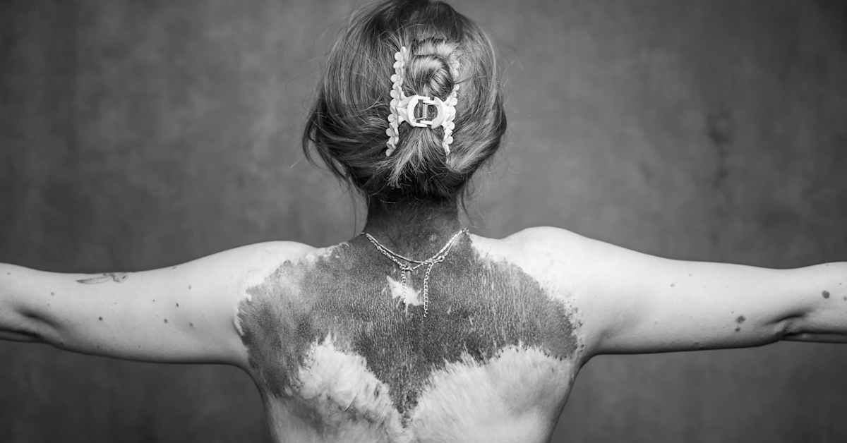 Sällsynt huddiagnos kräver förbättrad vårdpolitik